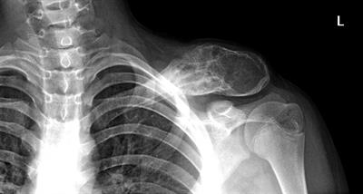Innovative method with two-stage surgery for Ewing sarcoma with personalized distal clavicle reconstruction: A case report and diagnosis review